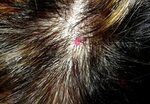 Hemangioma Auf Dem Kopf Rote Mole Auf Der Kopfhaut Mole Im H